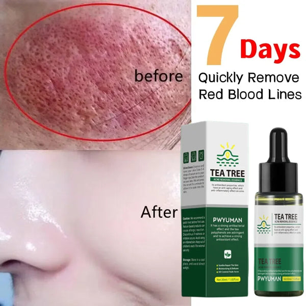 Rosacea Treatment Snail Serum - Soothing Moisturizer Korean Cosmetics
