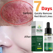Rosacea Treatment Snail Serum - Soothing Moisturizer Korean Cosmetics
