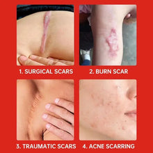 Fast Scar Removal Cream - Stretch Marks Burn Surgical Scars