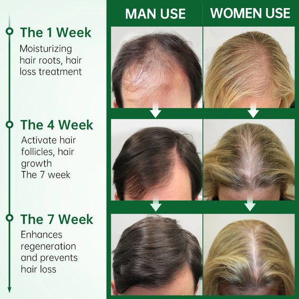PURC Rosemary Oil Hair Growth - Anti Hair Loss Treatment