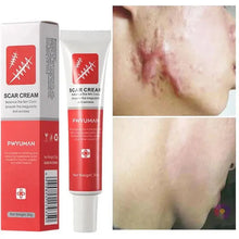 Fast Scar Removal Cream - Stretch Marks Burn Surgical Scars